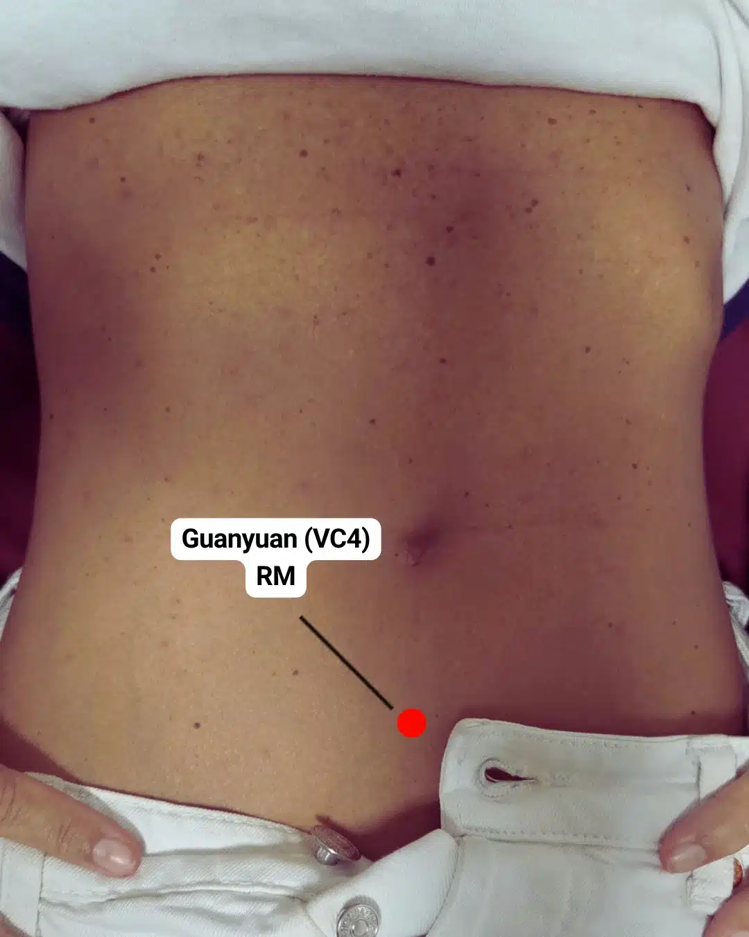 Ubicación del punto de digitopuntura Guanyuan (VC4) en el abdomen bajo