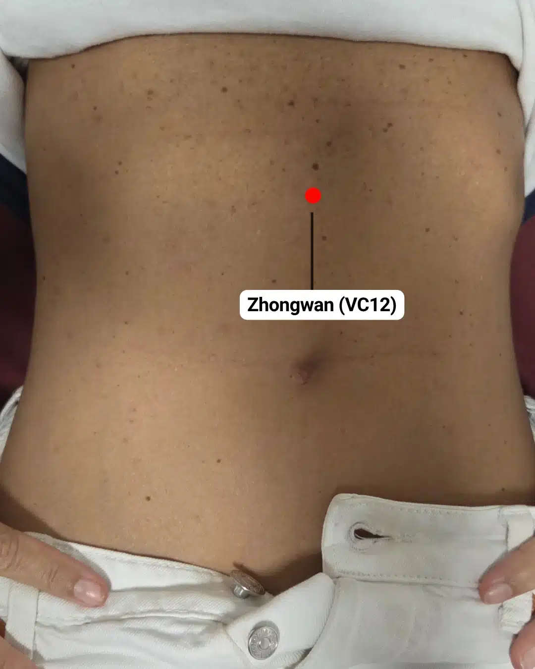 Ubicación del punto de digitopuntura Zhongwan (VC12) en el abdomen, entre el ombligo y el esternón